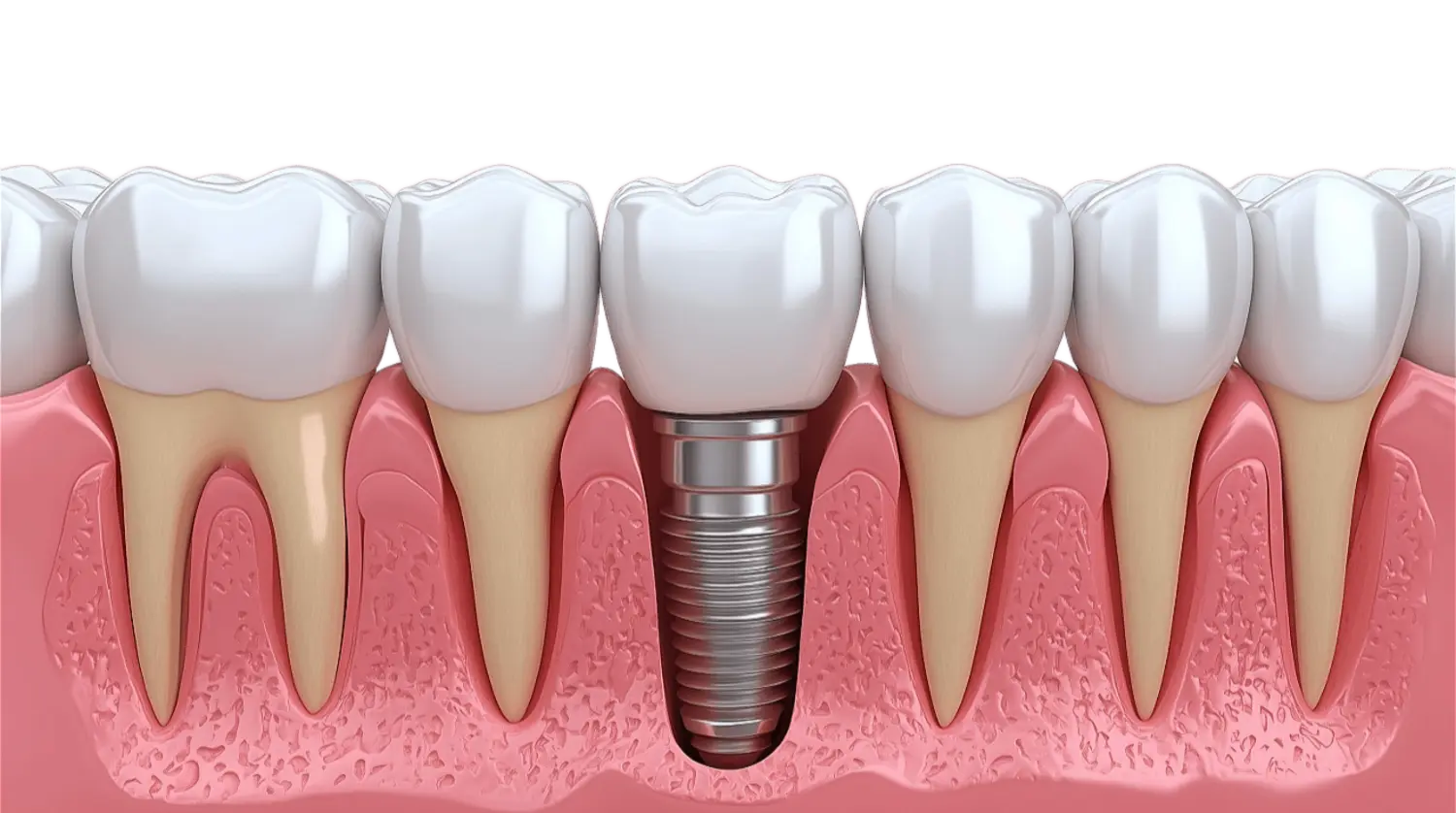 Баннер Дентальная имплантация зубов Баннер Дентальная имплантация зубов